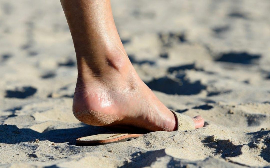 Fascite Plantare in Estate: perché il dolore al tallone peggiora con sandali e infradito